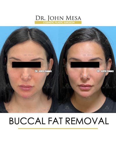 Buccal Fat Pad Removal Before & After Gallery - Patient 261114 - Image 1