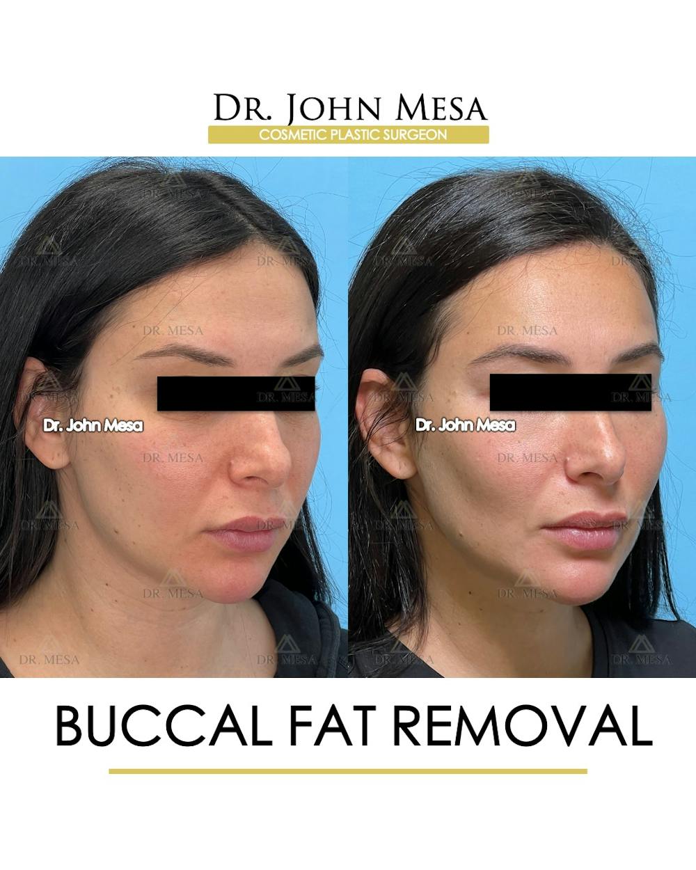 Buccal Fat Pad Removal Before & After Gallery - Patient 261114 - Image 2