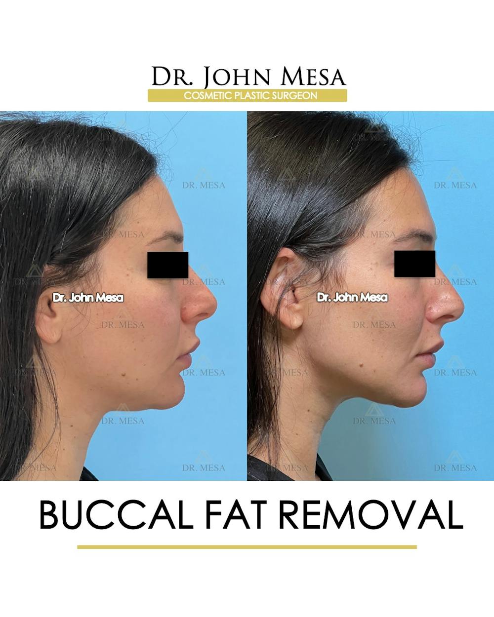 Buccal Fat Pad Removal Before & After Gallery - Patient 261114 - Image 3
