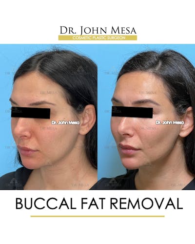 Buccal Fat Pad Removal Before & After Gallery - Patient 261114 - Image 4