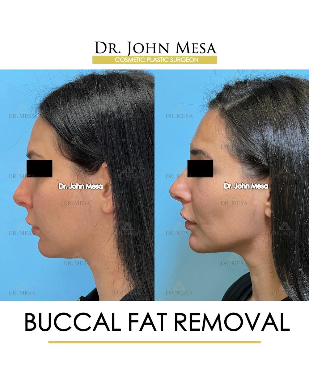 Buccal Fat Pad Removal Before & After Gallery - Patient 261114 - Image 5