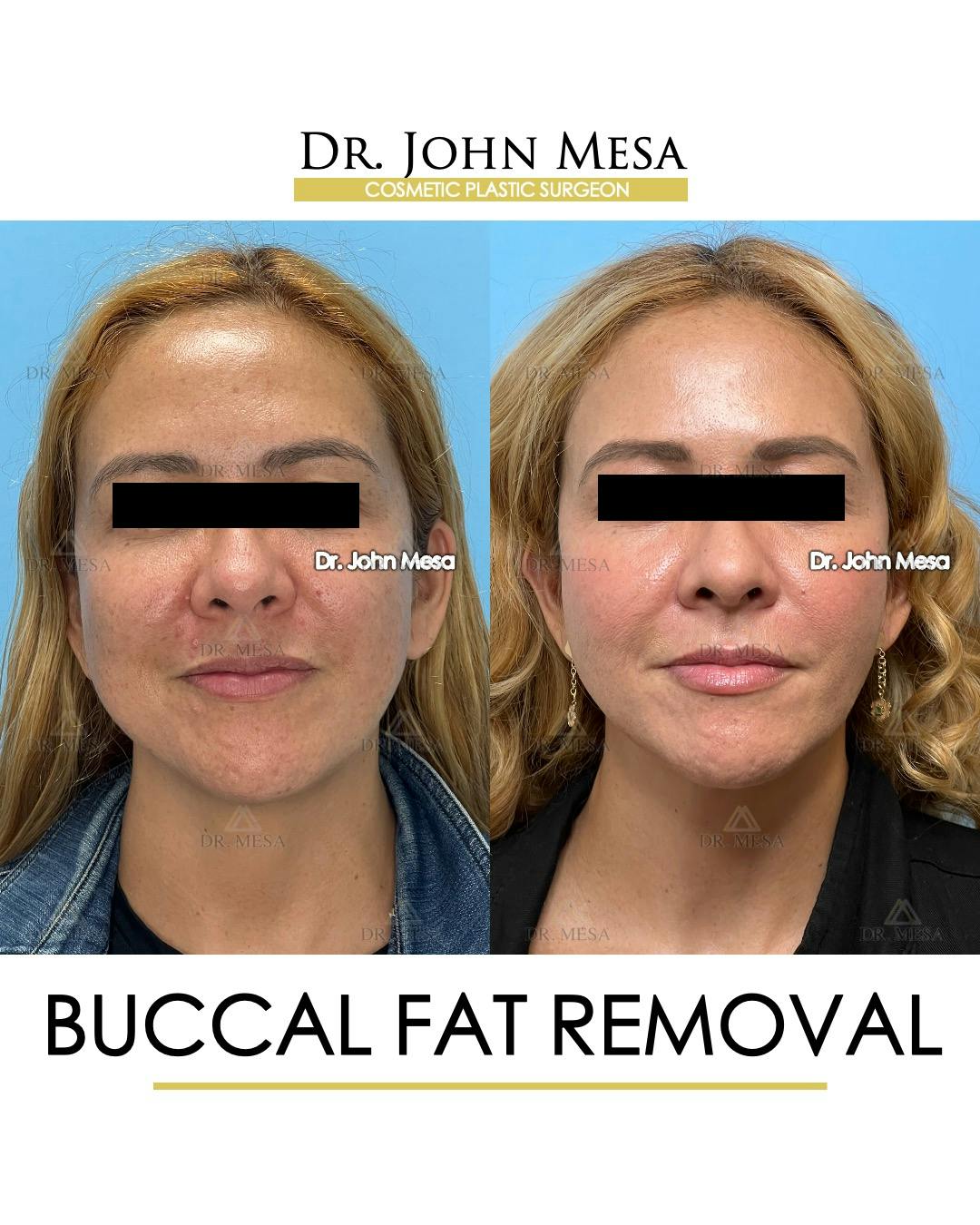 Pubic Fat Pad Removal | A Complete Guide To Pubic Fat Pad Removal – BUBQV