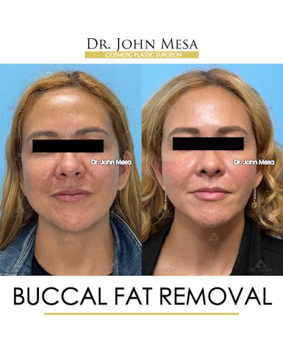 Buccal Fat Pad Removal Before & After Gallery - Patient 135747 - Image 1