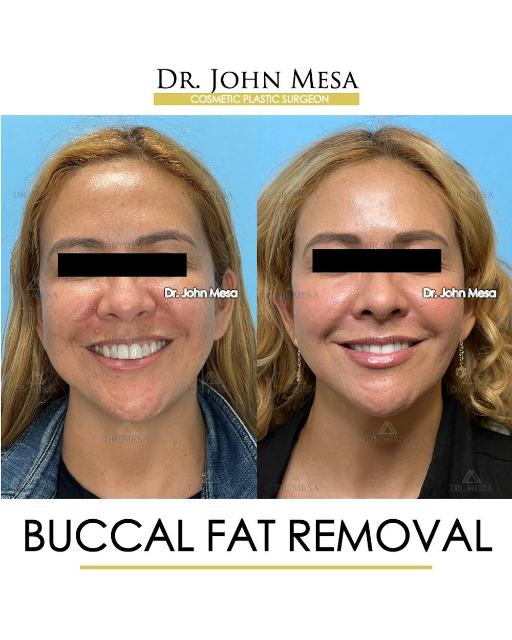 Buccal Fat Pad Removal Before & After Gallery - Patient 135747 - Image 2