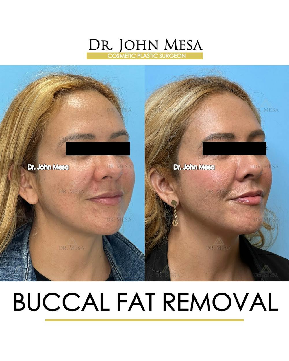 Buccal Fat Pad Removal Before & After Gallery - Patient 135747 - Image 3