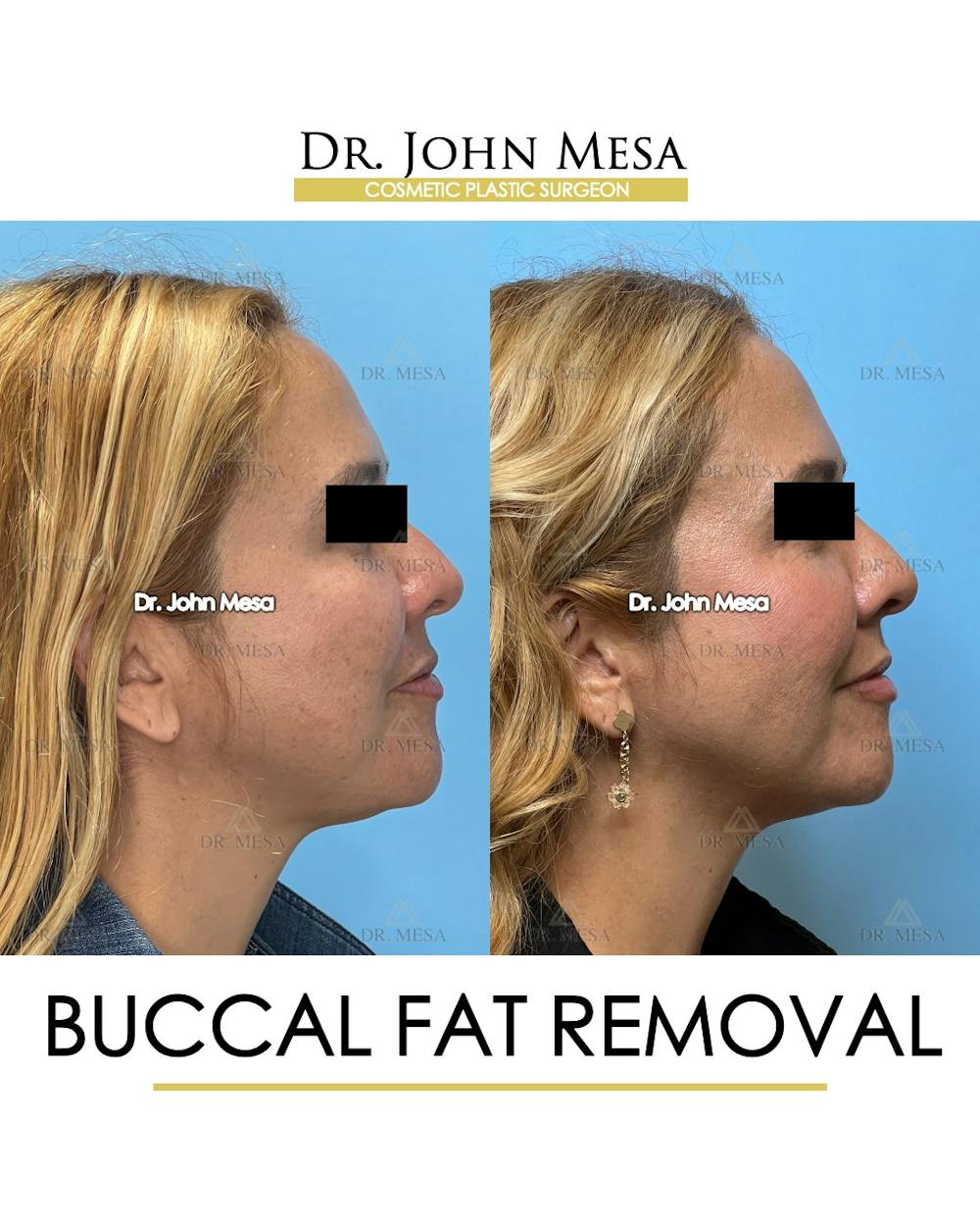 Buccal Fat Pad Removal Before & After Gallery - Patient 135747 - Image 4