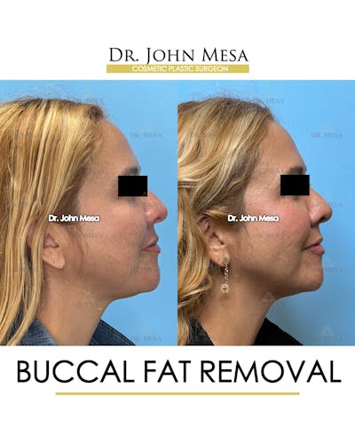 Buccal Fat Pad Removal Before & After Gallery - Patient 135747 - Image 4