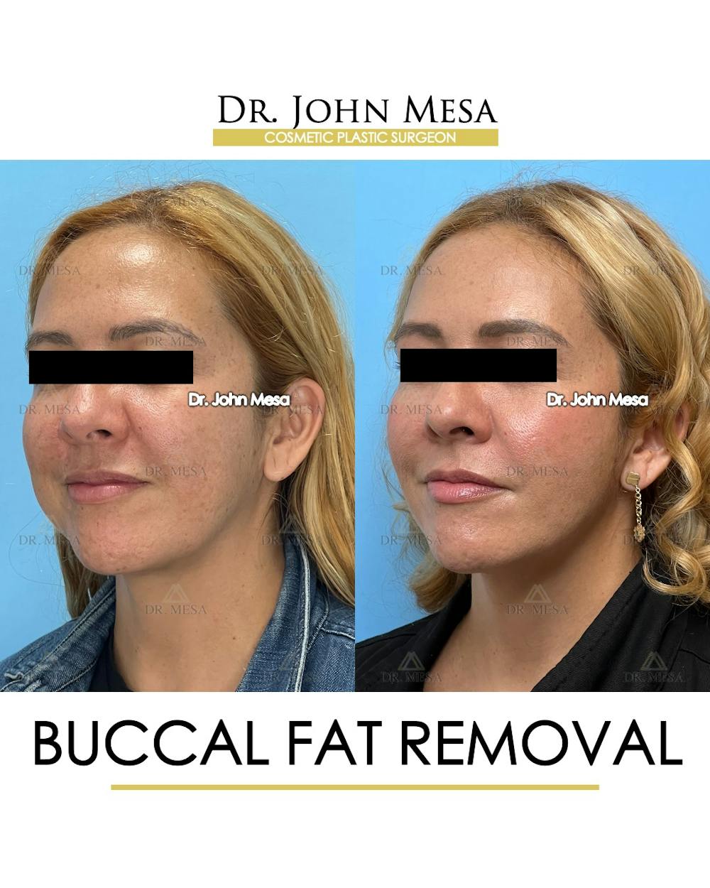 Buccal Fat Pad Removal Before & After Gallery - Patient 135747 - Image 5