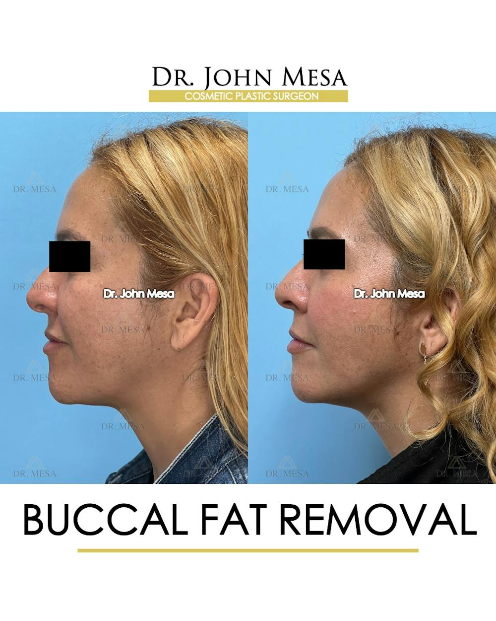 Buccal Fat Pad Removal Before & After Gallery - Patient 135747 - Image 6