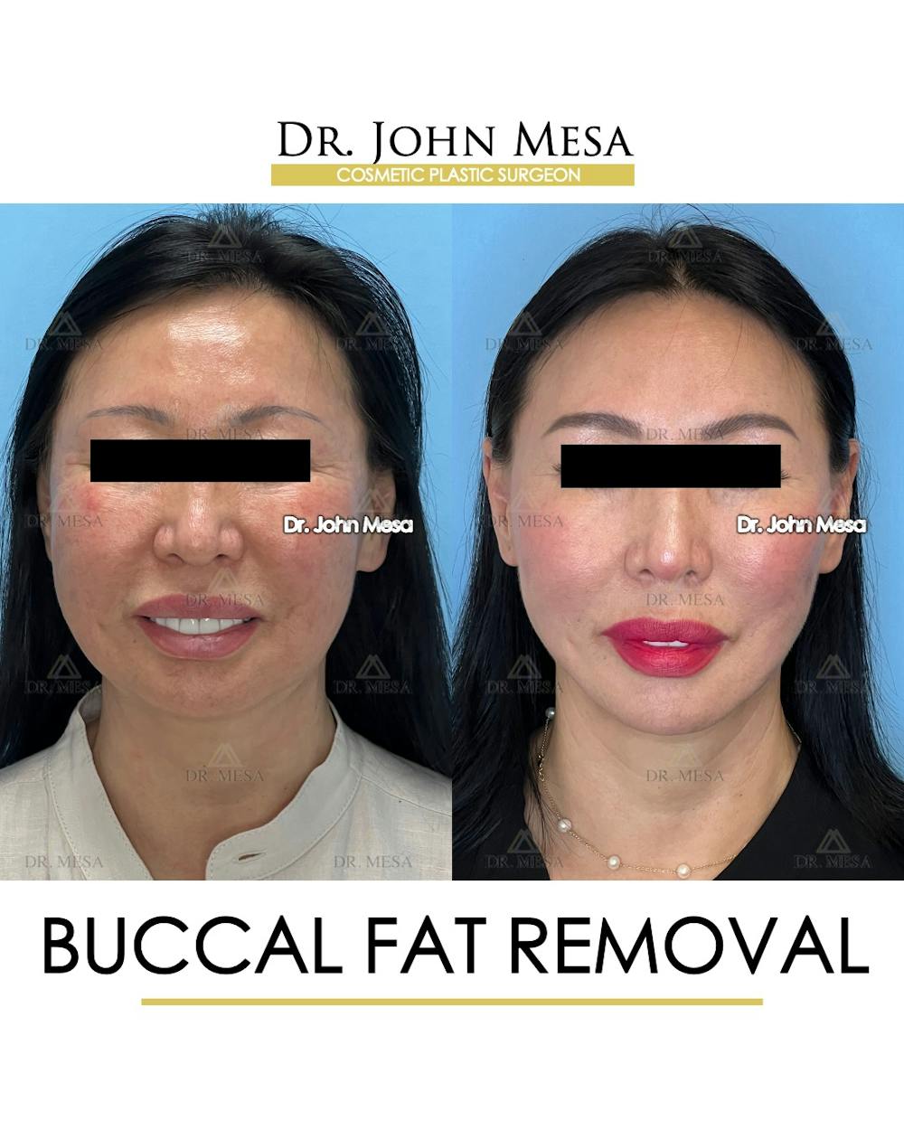 Buccal Fat Pad Removal Before & After Gallery - Patient 797248 - Image 2