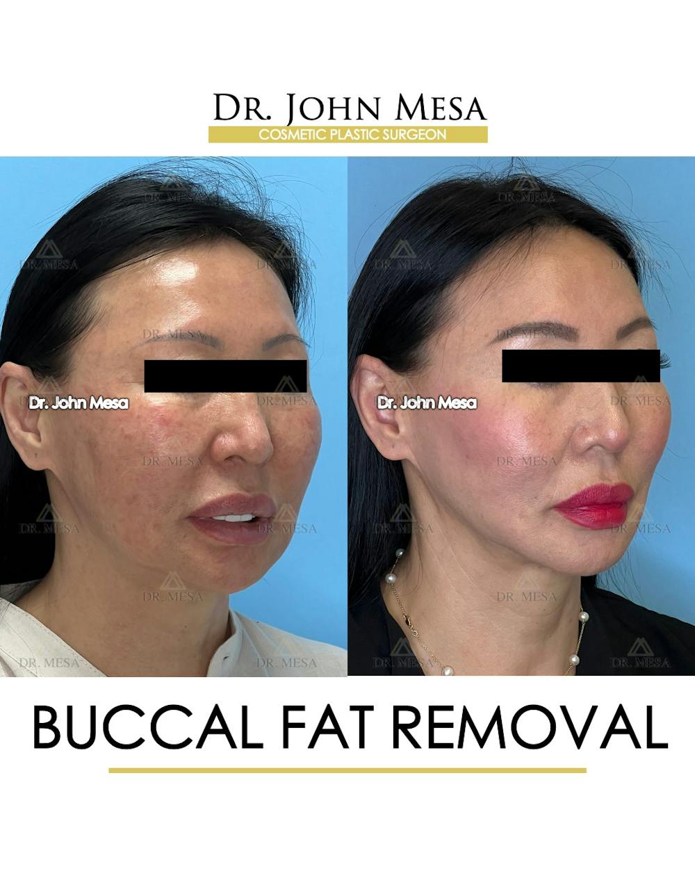Buccal Fat Pad Removal Before & After Gallery - Patient 797248 - Image 3