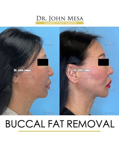 Buccal Fat Pad Removal Before & After Gallery - Patient 797248 - Image 4