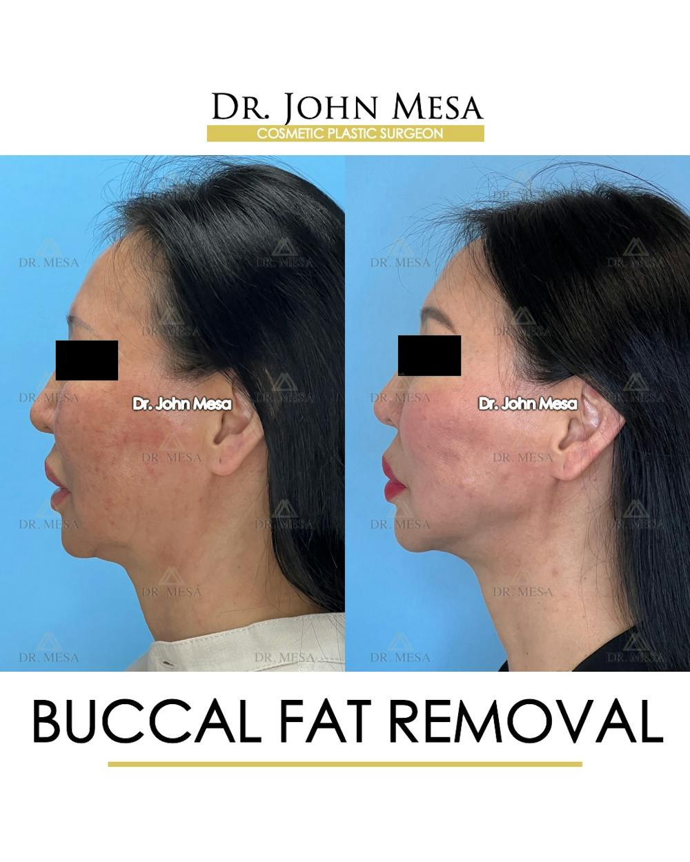 Buccal Fat Pad Removal Before & After Gallery - Patient 797248 - Image 6