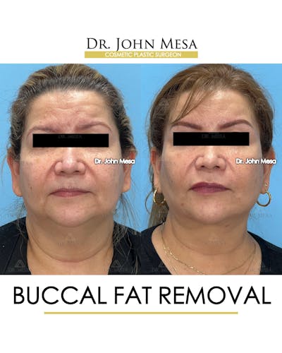 Buccal Fat Pad Removal Before & After Gallery - Patient 201863 - Image 1