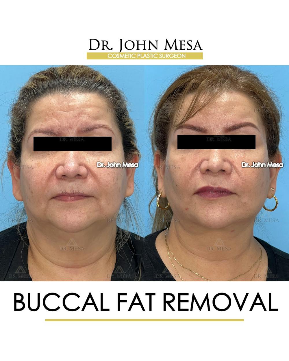 Buccal Fat Pad Removal Before & After Gallery - Patient 201863 - Image 1