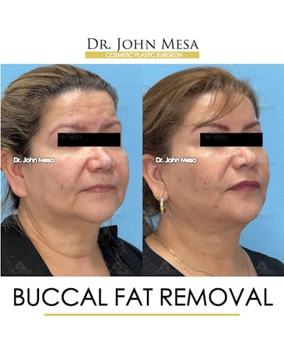 Buccal Fat Pad Removal Before & After Gallery - Patient 201863 - Image 2