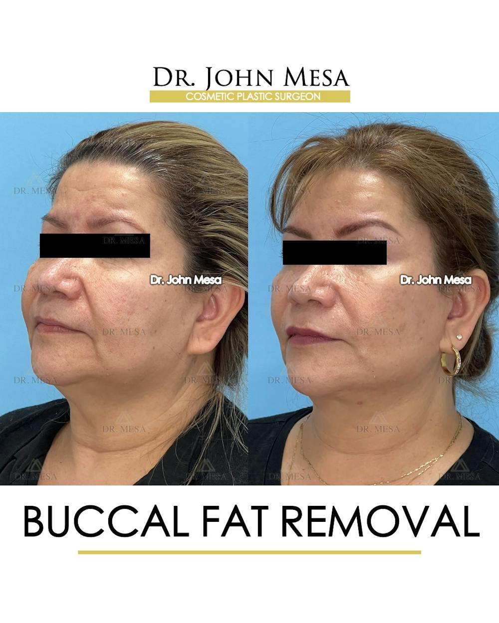 Buccal Fat Pad Removal Before & After Gallery - Patient 201863 - Image 3