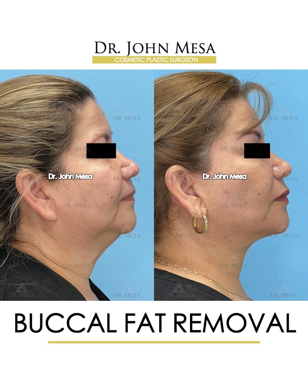 Buccal Fat Pad Removal Before & After Gallery - Patient 201863 - Image 4