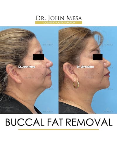Buccal Fat Pad Removal Before & After Gallery - Patient 201863 - Image 4