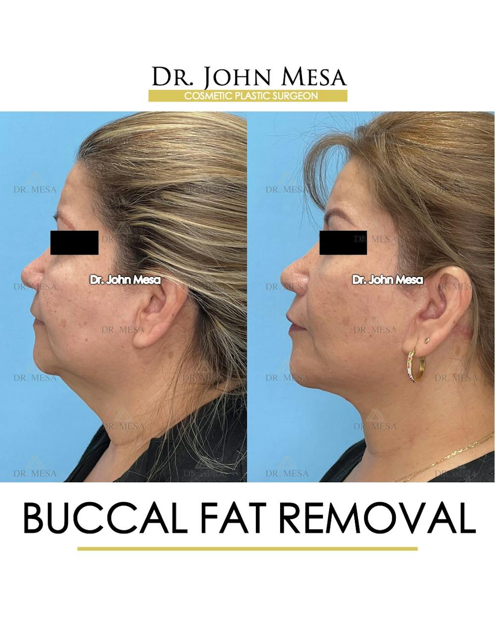 Buccal Fat Pad Removal Before & After Gallery - Patient 201863 - Image 5