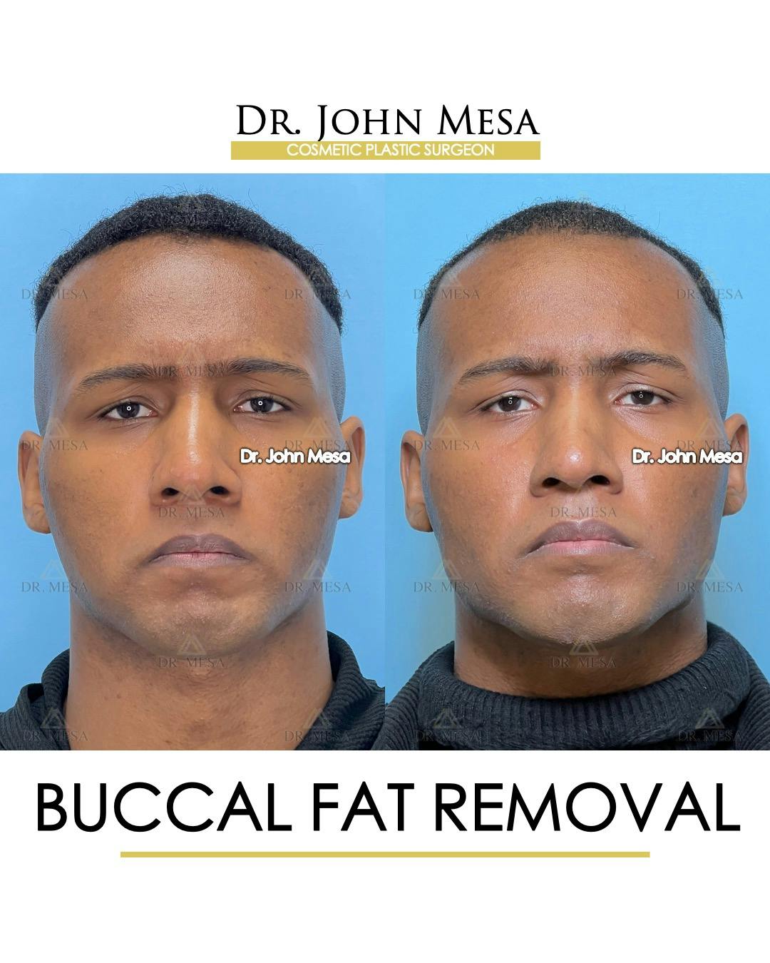 Buccal Fat Pad Removal for Men Before & After Gallery - Patient 187998 - Image 1