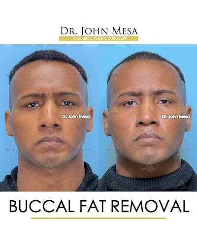Buccal Fat Pad Removal for Men Before & After Gallery - Patient 187998 - Image 1