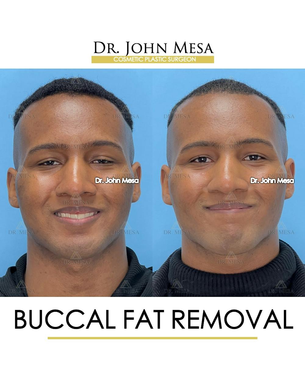 Buccal Fat Pad Removal for Men Before & After Gallery - Patient 187998 - Image 2