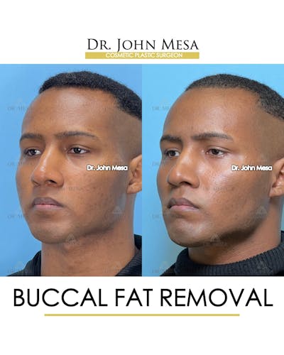 Buccal Fat Pad Removal for Men Before & After Gallery - Patient 187998 - Image 4