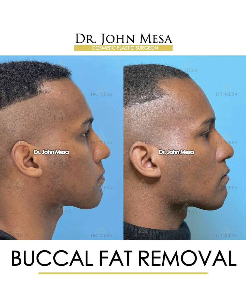Buccal Fat Pad Removal for Men Before & After Gallery - Patient 187998 - Image 5