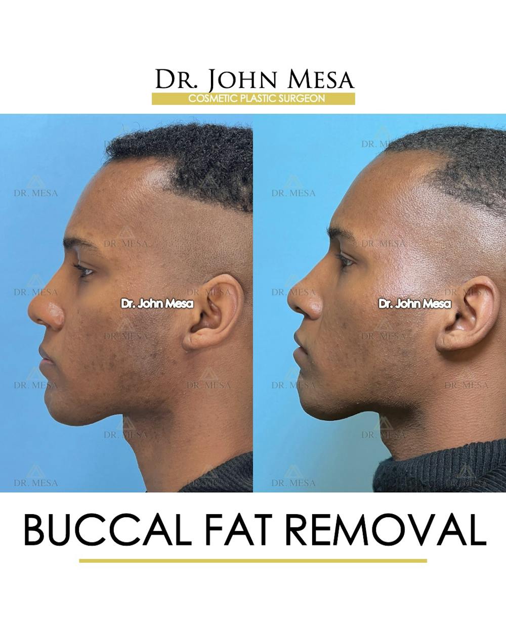 Buccal Fat Pad Removal for Men Before & After Gallery - Patient 187998 - Image 6