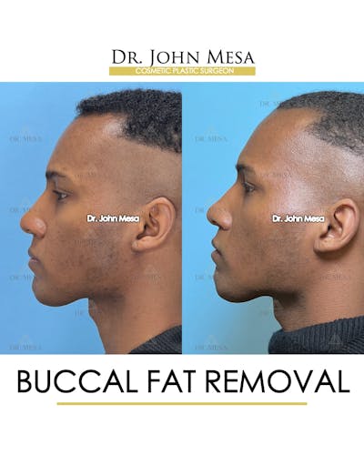 Buccal Fat Pad Removal for Men Before & After Gallery - Patient 187998 - Image 6