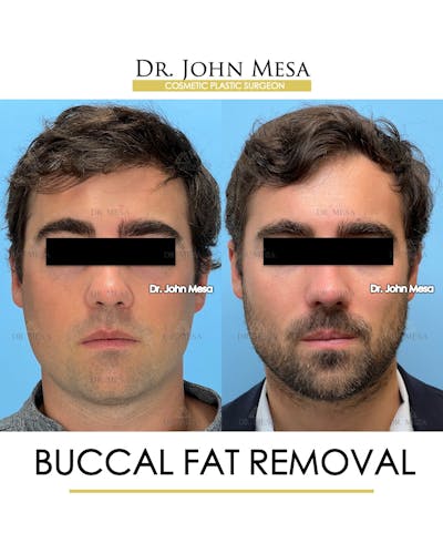 Buccal Fat Pad Removal for Men Before & After Gallery - Patient 107749 - Image 1