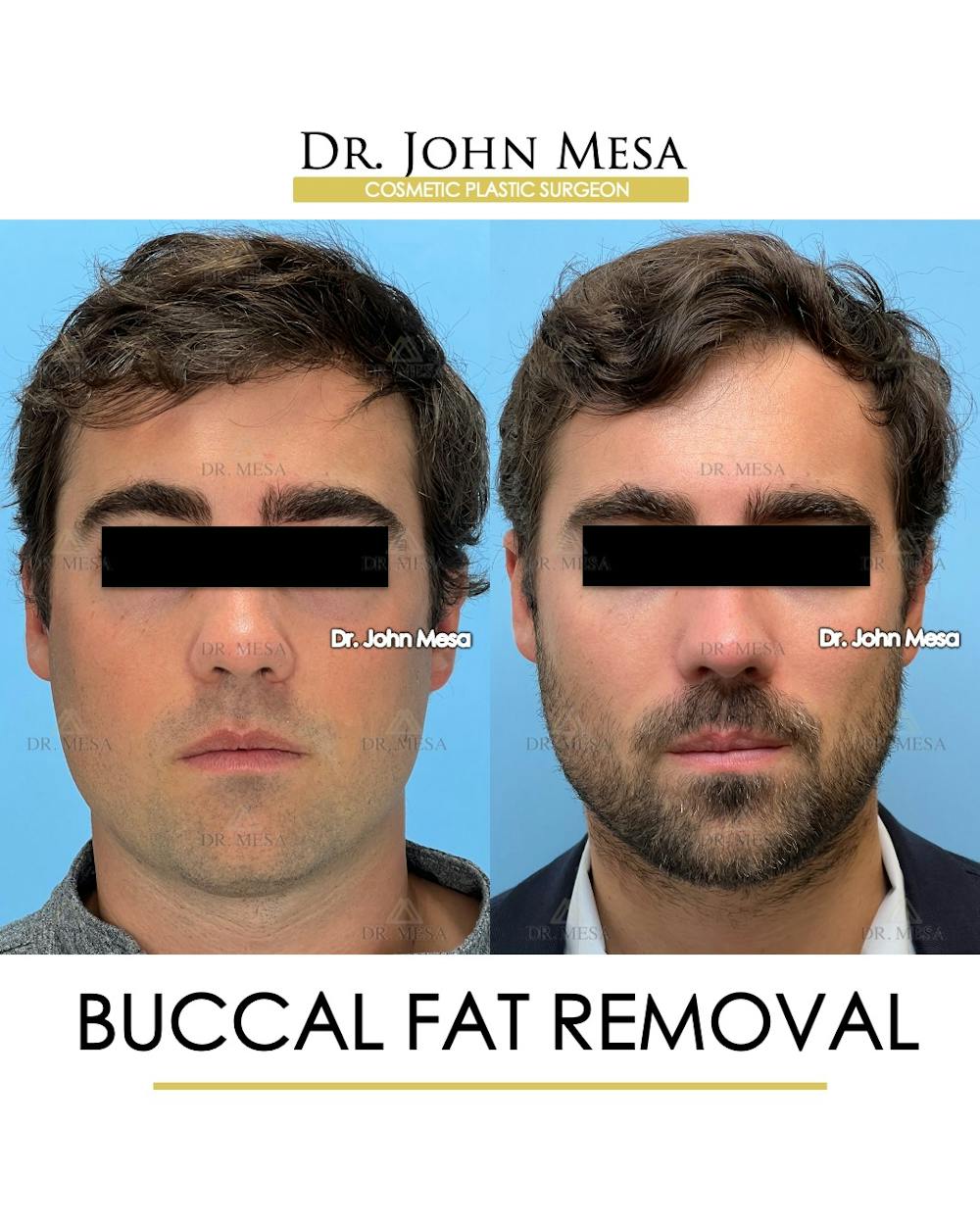 Buccal Fat Pad Removal for Men Before & After Gallery - Patient 107749 - Image 1