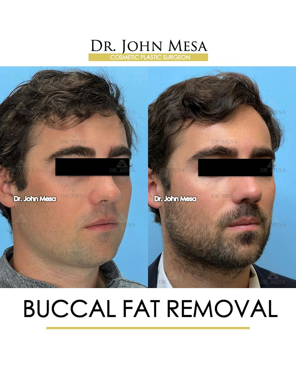 Buccal Fat Pad Removal for Men Before & After Gallery - Patient 107749 - Image 2