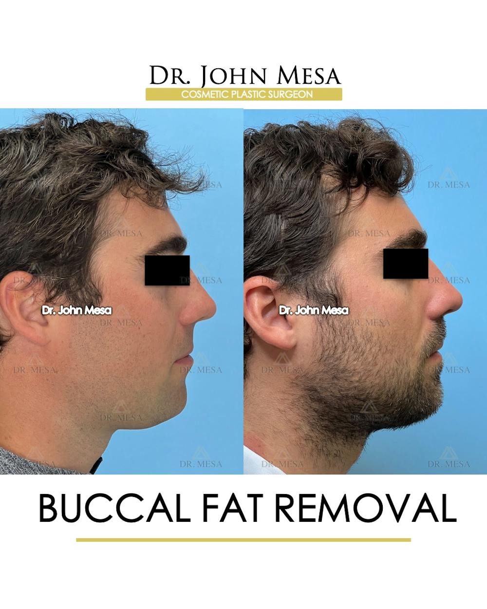Buccal Fat Pad Removal for Men Before & After Gallery - Patient 107749 - Image 3