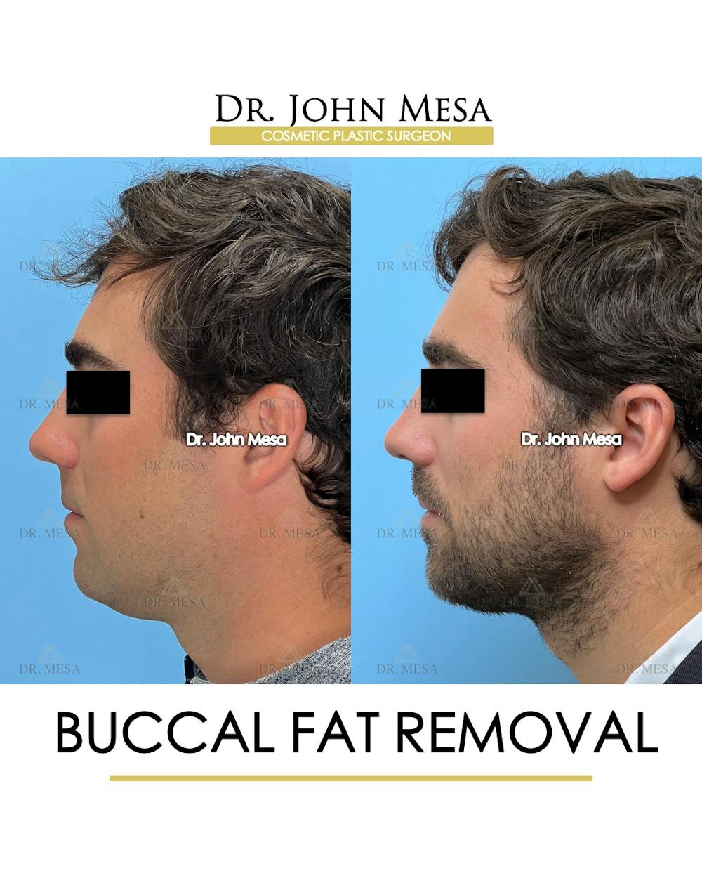Buccal Fat Pad Removal for Men Before & After Gallery - Patient 107749 - Image 4