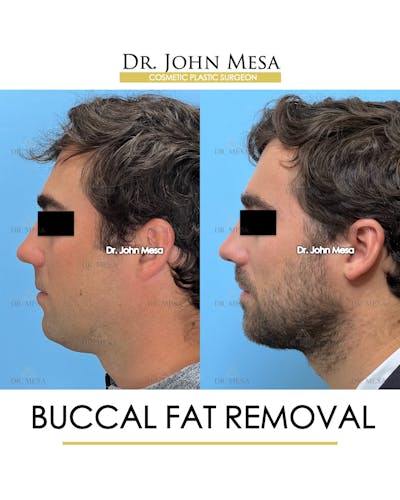 Buccal Fat Pad Removal for Men Before & After Gallery - Patient 107749 - Image 4