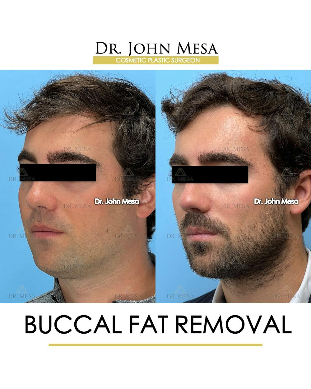 Buccal Fat Pad Removal for Men Before & After Gallery - Patient 107749 - Image 5