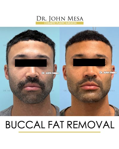 Buccal Fat Pad Removal for Men Before & After Gallery - Patient 348935 - Image 1