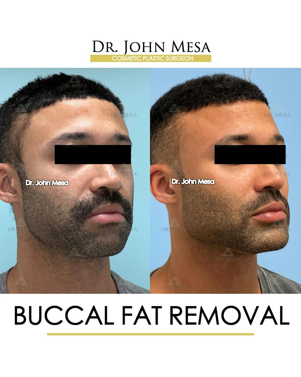 Buccal Fat Pad Removal for Men Before & After Gallery - Patient 348935 - Image 2