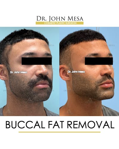 Buccal Fat Pad Removal for Men Before & After Gallery - Patient 348935 - Image 2