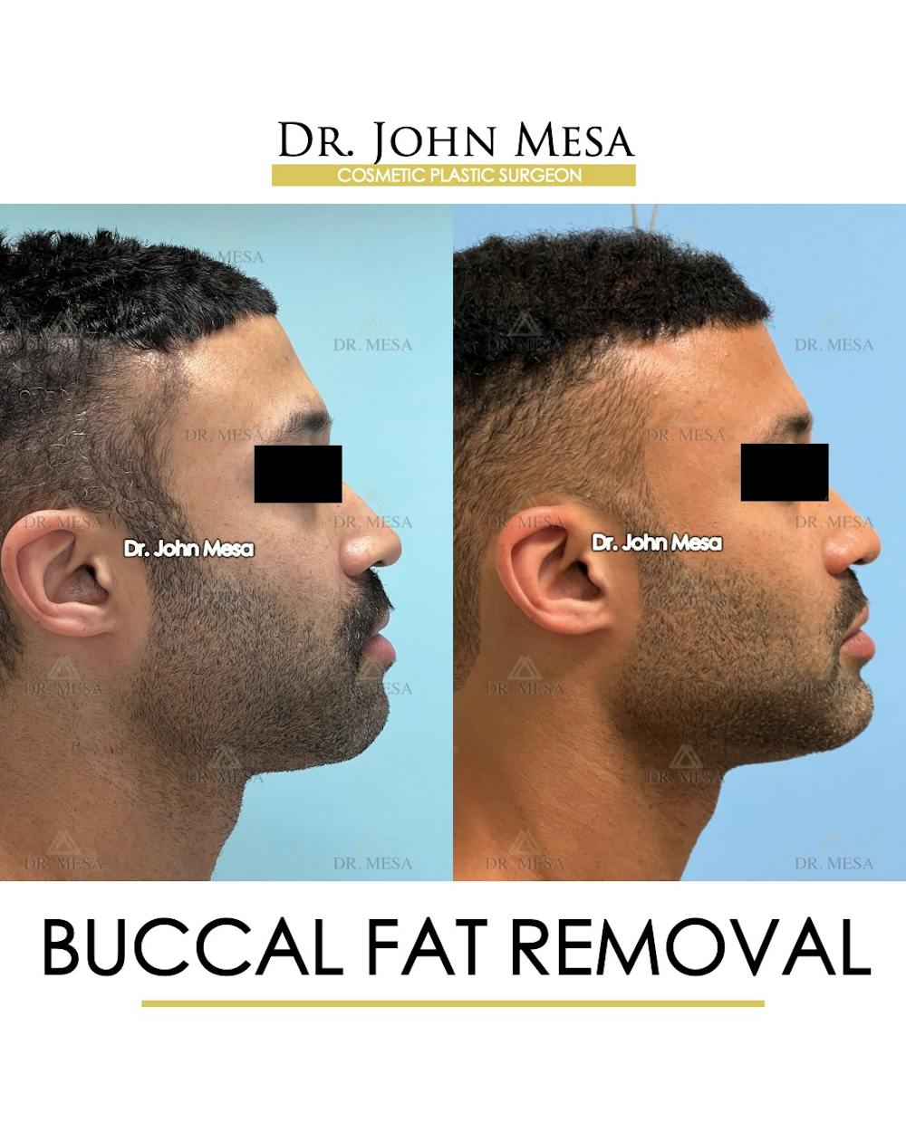Buccal Fat Pad Removal for Men Before & After Gallery - Patient 348935 - Image 3
