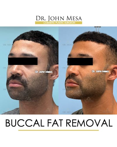 Buccal Fat Pad Removal for Men Before & After Gallery - Patient 348935 - Image 4