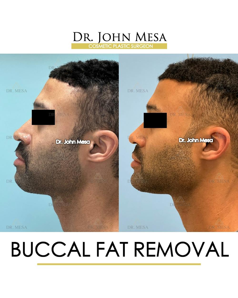 Buccal Fat Pad Removal for Men Before & After Gallery - Patient 348935 - Image 5