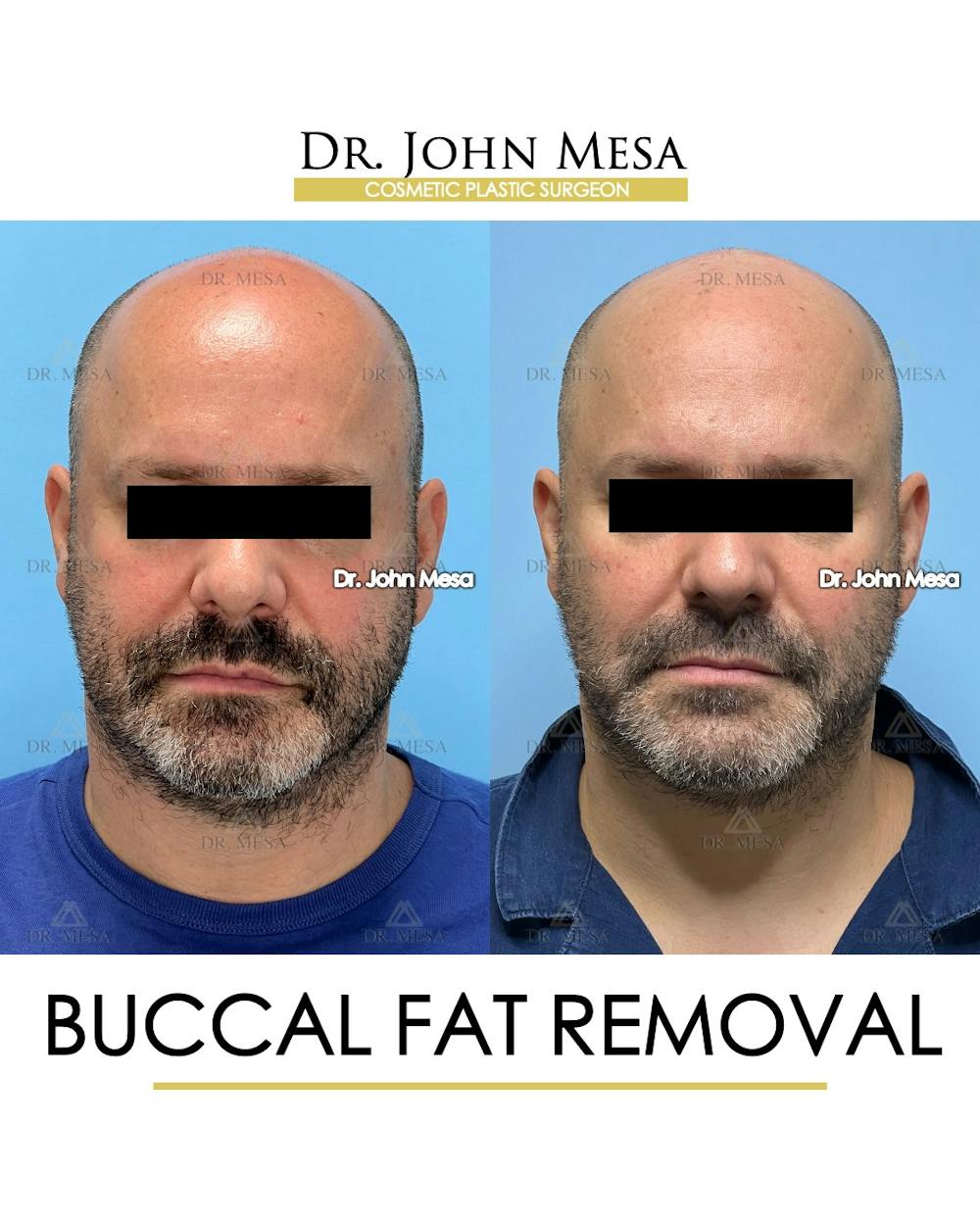 Buccal Fat Pad Removal for Men Before & After Gallery - Patient 286423 - Image 1