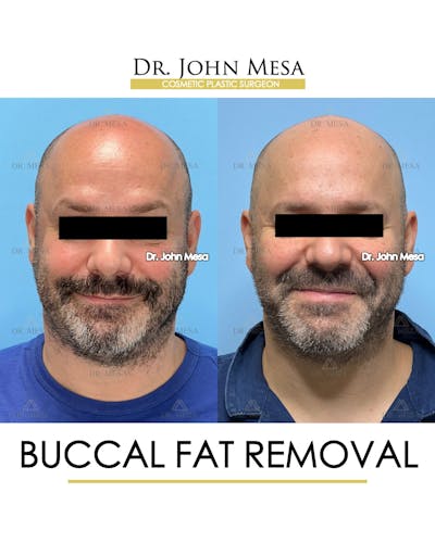 Buccal Fat Pad Removal for Men Before & After Gallery - Patient 286423 - Image 2