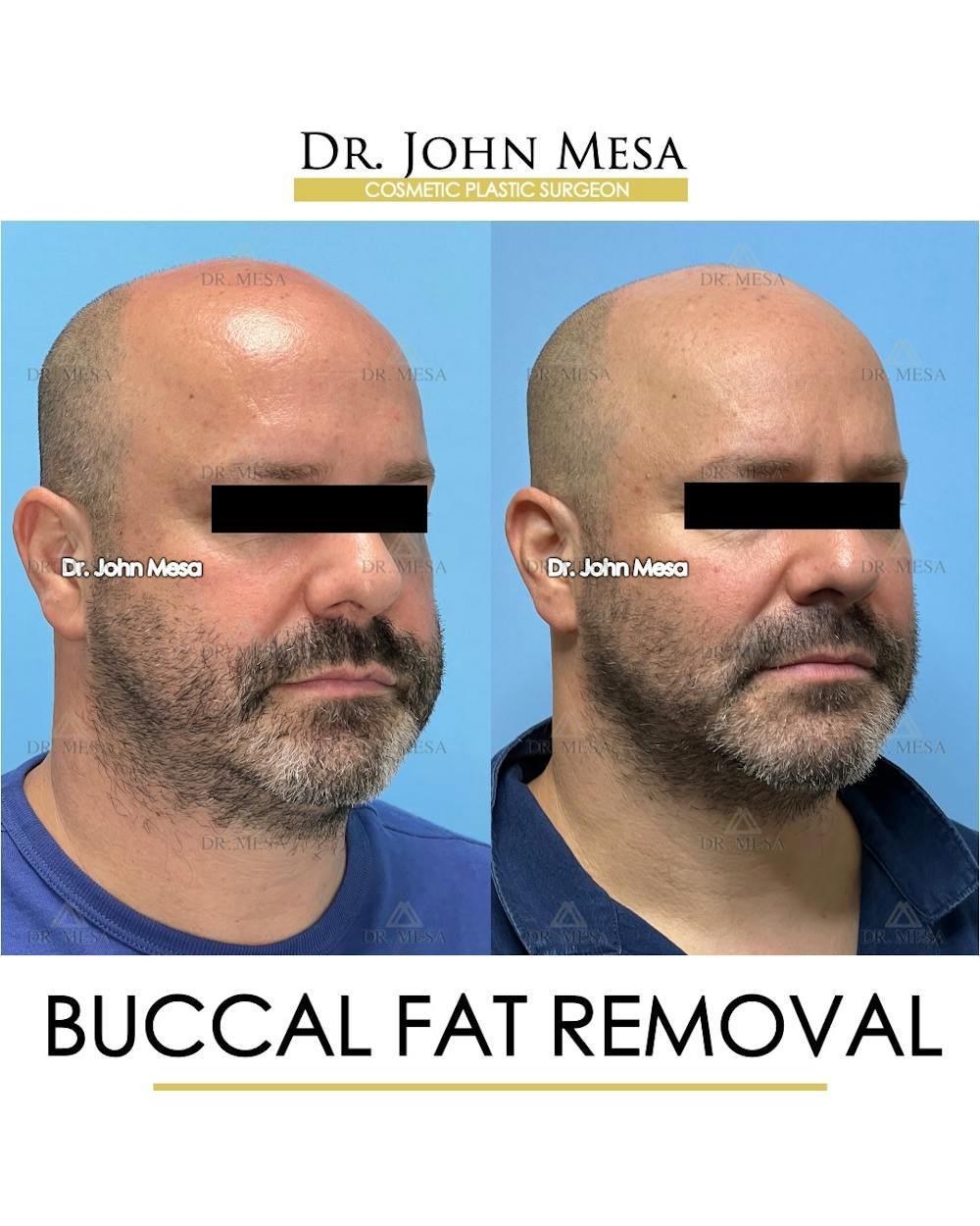 Buccal Fat Pad Removal for Men Before & After Gallery - Patient 286423 - Image 3