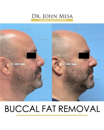 Buccal Fat Pad Removal for Men Before & After Gallery - Patient 286423 - Image 4