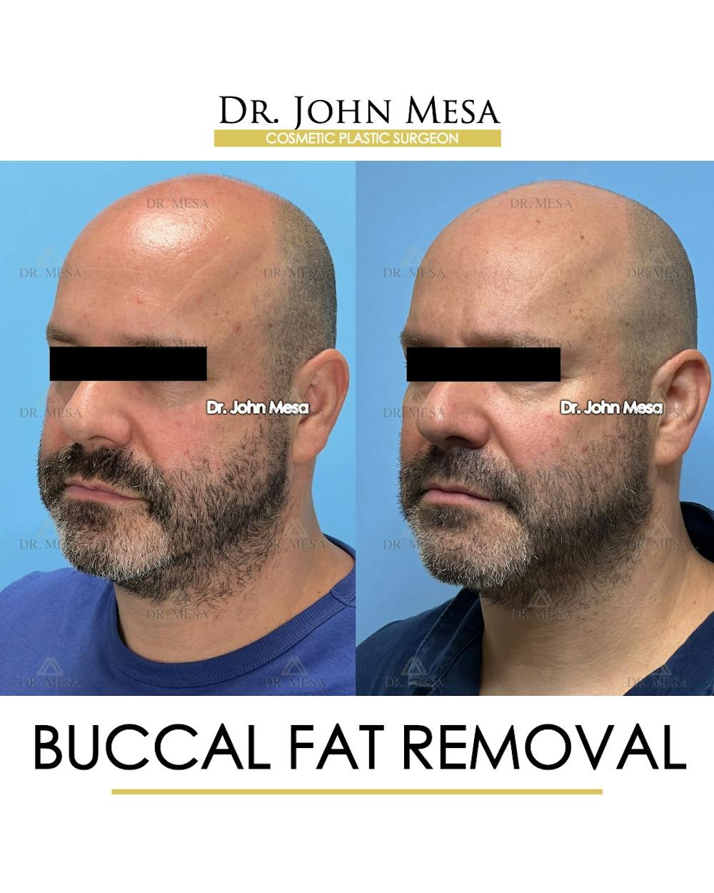 Buccal Fat Pad Removal for Men Before & After Gallery - Patient 286423 - Image 5