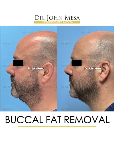Buccal Fat Pad Removal for Men Before & After Gallery - Patient 286423 - Image 6